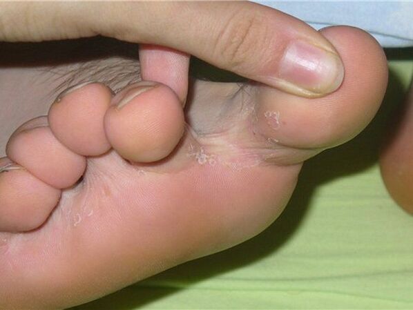 simptomi glivic na nohtih