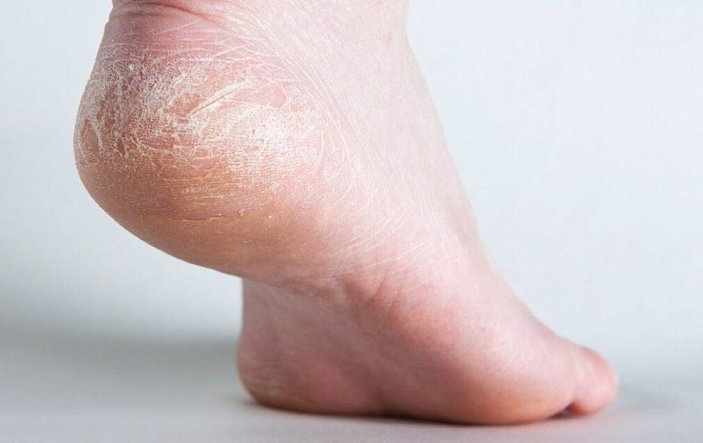 glivice na koži stopal