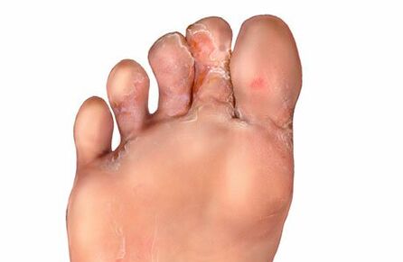 simptomi glivic na nogah