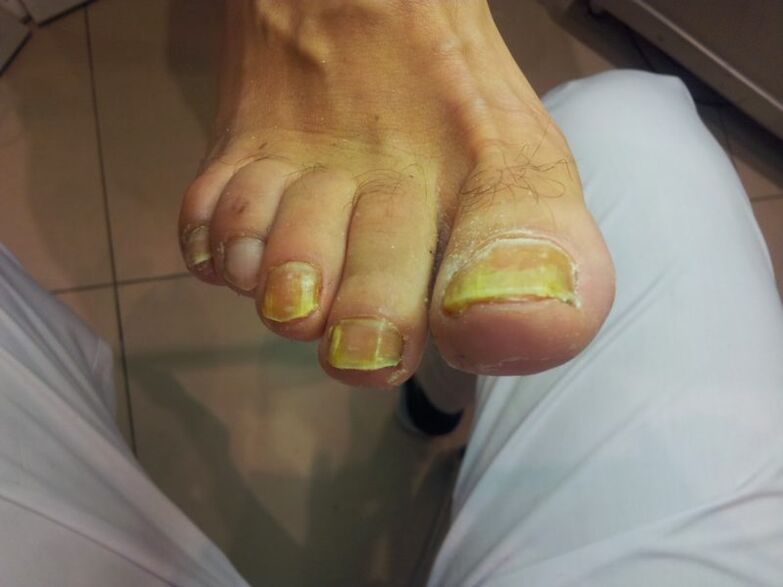 rumeni nohti na nogah z glivicami