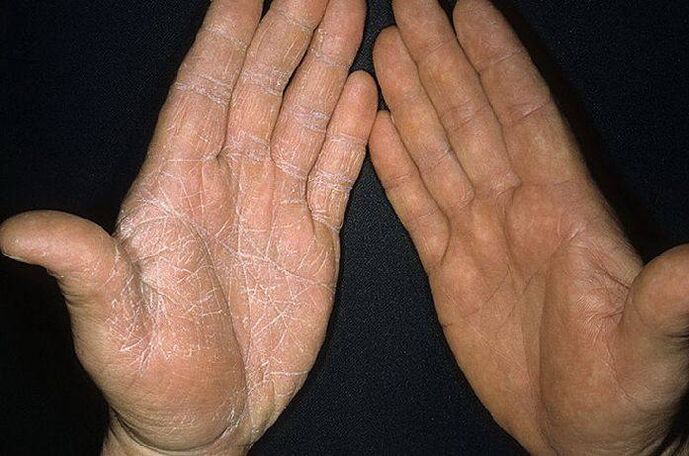 simptomi glivice na koži rok