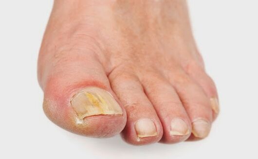 Klinična slika glivice je pojav madežev na nohtih