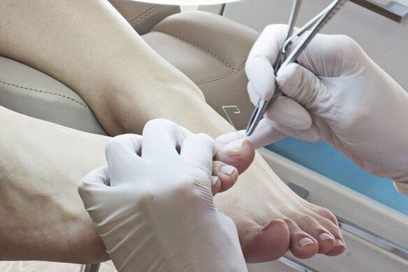 Mehansko odstranjevanje nohtov na nogah, ki jih je prizadela gliva