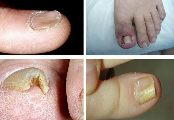 Simptomi onihomikoze na nogah