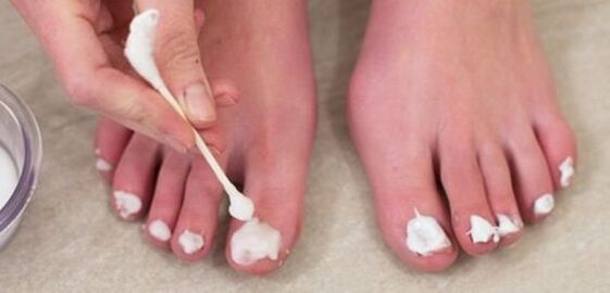 zdravljenje glivic na nohtih z mazilom
