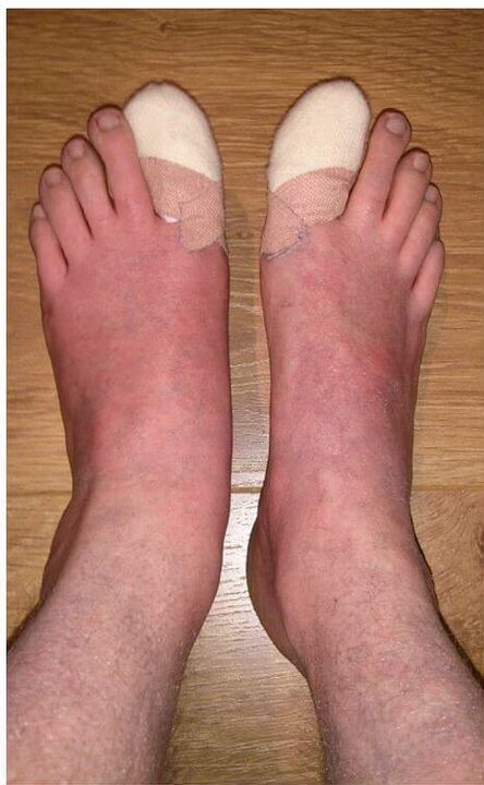odstranjevanje nohtov na nogah, ki jih je prizadela gliva