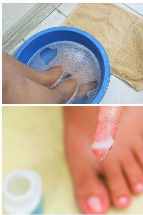 uporaba naravnih olj pri zdravljenju glivic na nohtih na nogah