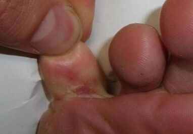 razpoka na prstu je posledica glivične okužbe