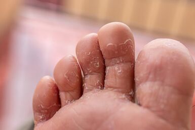 simptomi glivičnih okužb prstov na nogah